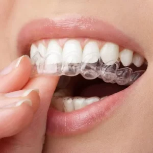 Usynlig tannregulering med Invisalign-skinner